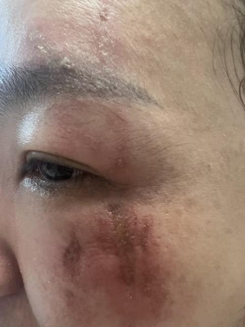 身上落这种小虫千万别拍 堪比泼强酸会灼伤皮肤